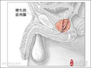前列腺增生的原因有几大因素